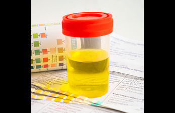 Urine Drug Test: What You Need to Know