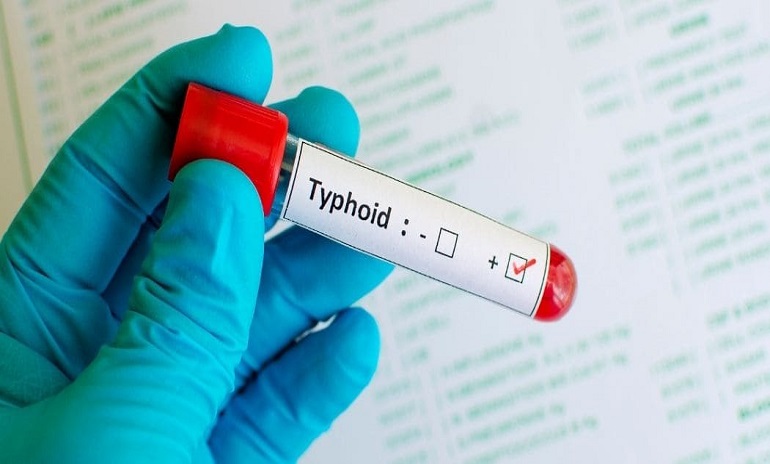 What Do Typhoid IgG and IgM Positive Mean In tests?